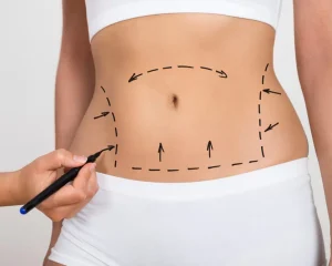 abdominoplastia-2