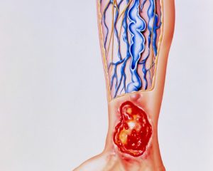 venous-ulcers